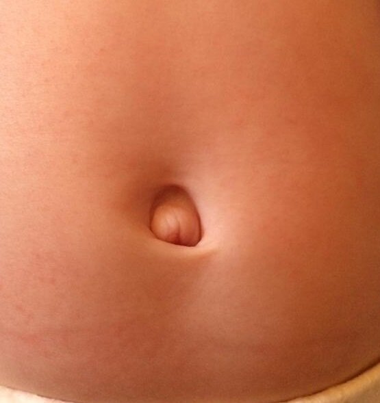 Возможно пупочная или параумбиликальная грыжа