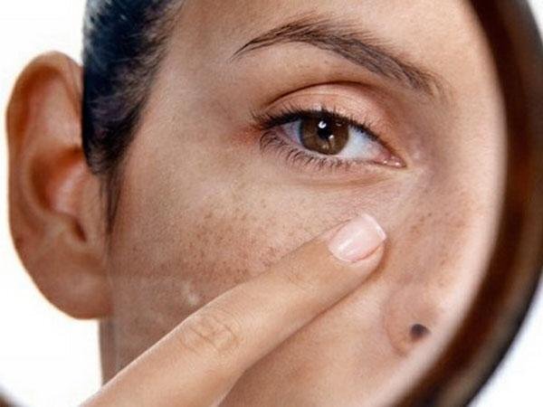 Как избавиться от пигментных пятен на лице? - Coolaser Clinic