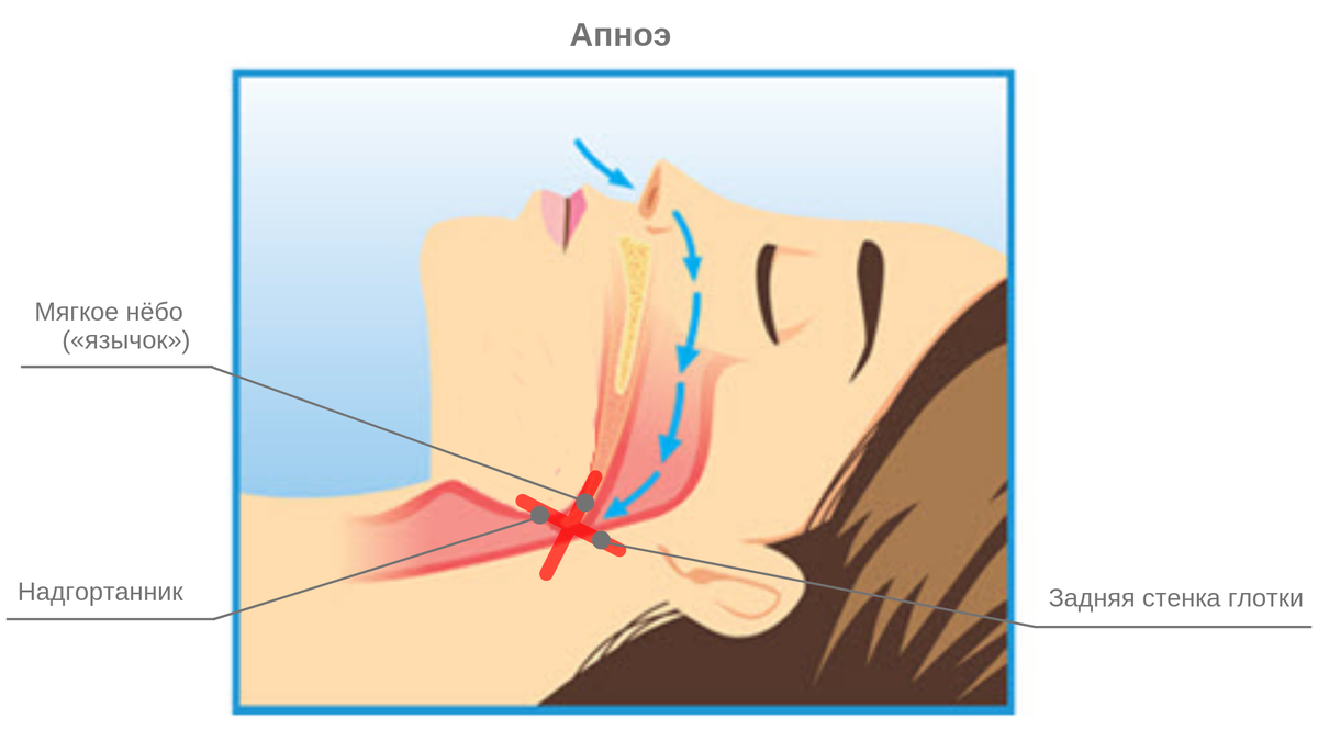 Механизм формирования апноэ сна.