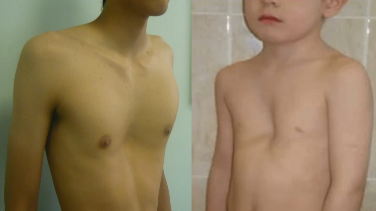 Деформация грудной клетки у детей и подростков