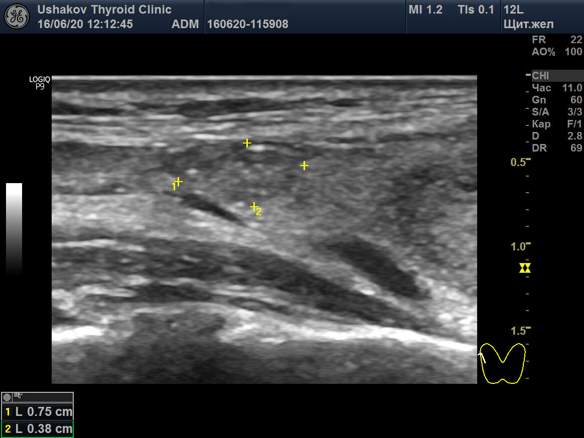 Нечеткие неровные контуры гипоэхогенное. Гипоэхогенный узел щитовидной железы на УЗИ. УЗИ щитовидной железы узел левой доли. Узел щитовидной железы УЗИ картина. Добавочная доля щитовидной железы на УЗИ.