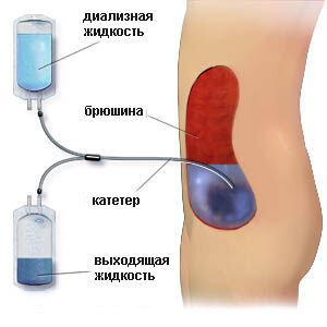 https://www.google.com/url?sa=i&url=https%3A%2F%2F03uro.ru%2Furopedia%2Fperitoneal-dialysis&psig=AOvVaw0Itg6zTx9HaRcmu9U35894&ust=1594739467012000&source=images&cd=vfe&ved=0CAIQjRxqFwoTCLCr9f3ByuoCFQAAAAAdAAAAABAu