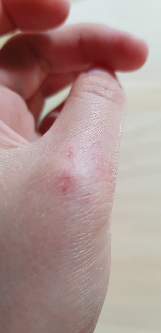 Атопический дерматит