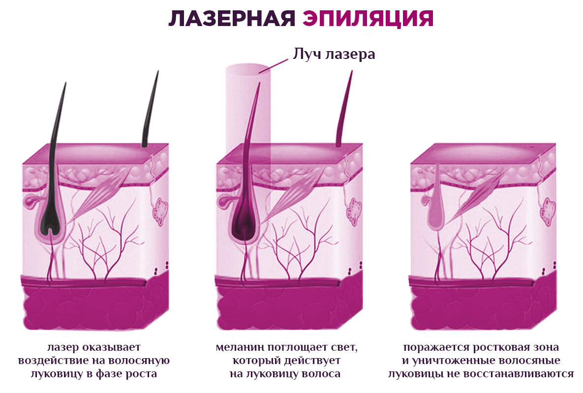 Как выбрать свой лазер для удаления волос? Какие лазеры бывают: александрит, диодный, неодимовый, IPL