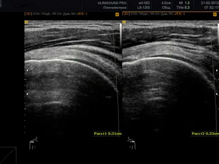 Узи плечевого. УЗИ тазобедренного сустава артроз. УЗИ коленного сустава Medison. Тендовагинит плечевого сустава на УЗИ. Бурсит плечевого сустава УЗИ мрт.