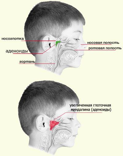 расположение аденоидов