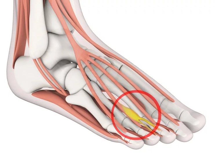 Невринома стопы
