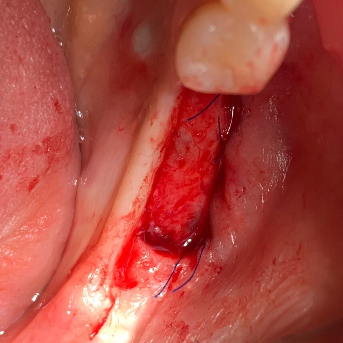 Для восстановления зубов 36 и 37 провели: 
📌расщепление костной ткани + горизонтальная аугментация (подсадка кости по ширине) с одномоментной установкой двух имплантантов.

📌из-за недостатка прикрепленной слизистой пересадил свободный десенной трансплантат с нёба

📌после приживления десны провели установку формирователей и протезирование циркониевыми коронками
⠀
⚡️Идея работы в том, чтобы не просто провести установку имплантантов с одновременным расщеплением кости.

⚡️А задача выполнить восстановление кости, зубов так, чтобы это было на длительный срок, на всю жизнь.

⚡️Для этого нужно, чтобы ширина кости была восстановлена до идеальной. Но не менее важно создать вокруг имплантантов прикрепленную неподвижную десну, чтобы налёт и микробы не попадали под десну и не приводили к воспалению и периимплантиту.


_______________________
📨Если у Вас появились вопросы или Вам нужна моя консультация:
⠀
🔊Можно заполнить форму на сайте: grantsev.ru или написать в Директ 👉@dr.grantsev или заполнить форму на сайте grantsev.ru 
⠀
📝Записаться на консультацию в клинику можно написав на мой личный телефон в Watsapp: +79852385115
Или позвонив по телефону:
+74957892005;
+79652158357;
⠀
▶ Первичная консультация в один клик: https://wapp.click/79652158357
⠀
📨 Также Вы можете написать мне на email: doctor-grantsev@yandex.ru
⠀
(Я всегда отвечаю лично т.к. знаю, что Вы доверяете мне самое ценное - Здоровье)
⠀
📍Адрес клиники Grantsev Clinic: г.Москва, Лялин переулок, дом 3 стр 4.
⠀
✅ Доктор Гранцев в других социальных сетях:
⠀
▶https://www.instagram.com/dr.grantsev/
⠀
▶https://vk.com/dr.grantsev
⠀
▶https://www.facebook.com/dr.grantsev
⠀
▶https://ok.ru/doctor.grantsev
⠀
▶https://t.me/GrantsevClinic
⠀
▶https://mobile.twitter.com/DoctorGrantsev
⠀
▶https://vt.tiktok.com/ZSdUuU1m9/
⠀
▶https://rutube.ru/channel/25463332/
⠀
#GrantsevClinic​​​​ #Grantsev​​ #PoZubam​​ #grantsev.ru
#Grantsev_Surgery
#Grantsev_Implantology
#Grantsev_Implant
#Гранцев_Хирургия
#Гранцев_Имплантология
#Гранцев_Импланты

 