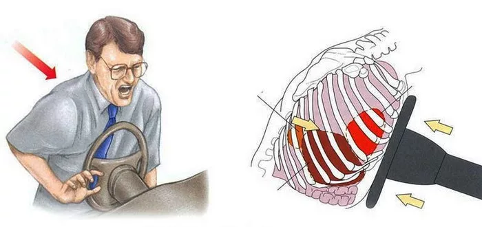 Повреждение грудной клетки о рулевое колесо может привести в том числе к патологиям сердца