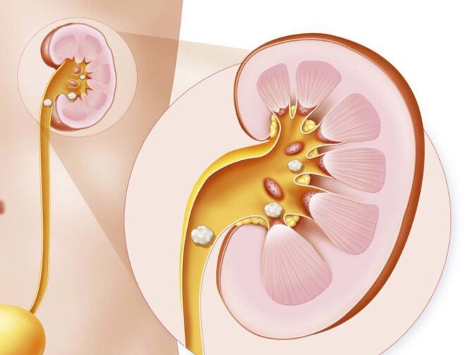 Почки месячные. Солевые отложения в почках. Конкременты в почках солевые. Отложение камней в почках.