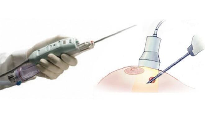 Что такое пункция молочной железы. Вакуумная аспирационная биопсия ваб. Тонкоигольная аспирационная биопсия. Вакуум аспирационная биопсия молочной железы. Вакуумная аспирационная биопсия фиброаденомы молочной железы.