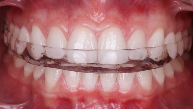 защитная капа