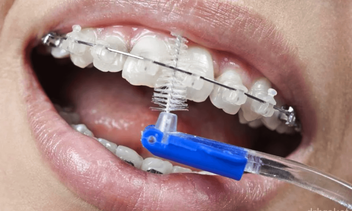 Ёршик - важный этап гигиены с брекетами