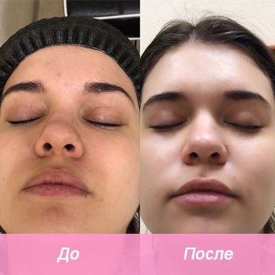 результат химического пилинга