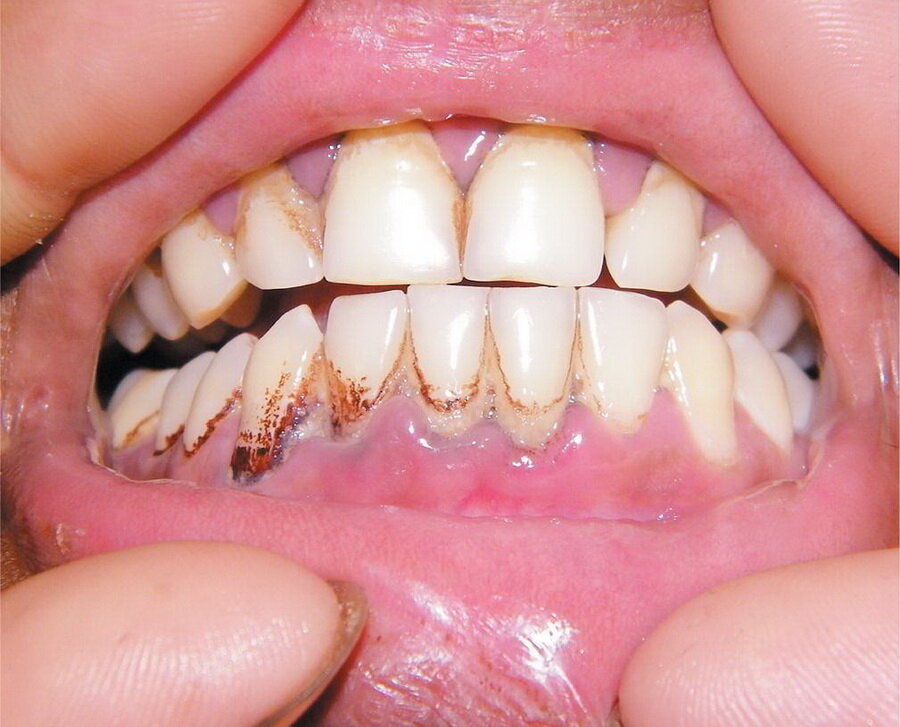 Проявления цинги