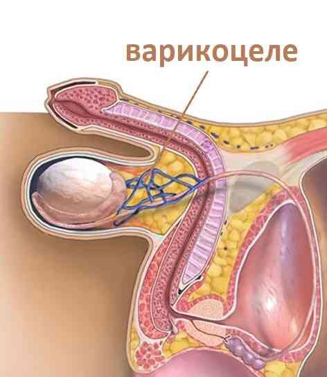 Бесплодие после операции варикоцеле