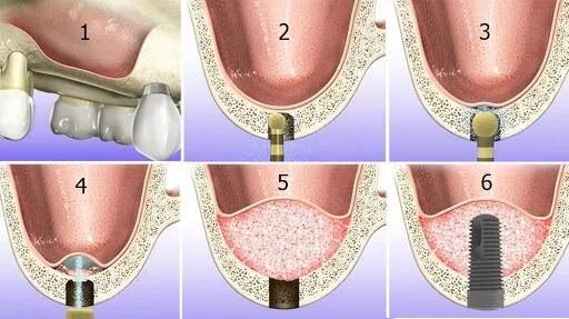 Схема закрытого синус лифтинга. Фото взято с сайта https://implantolog-fedorov.ru/uslugi/implantatsiya-zubov/sinus-lifting/