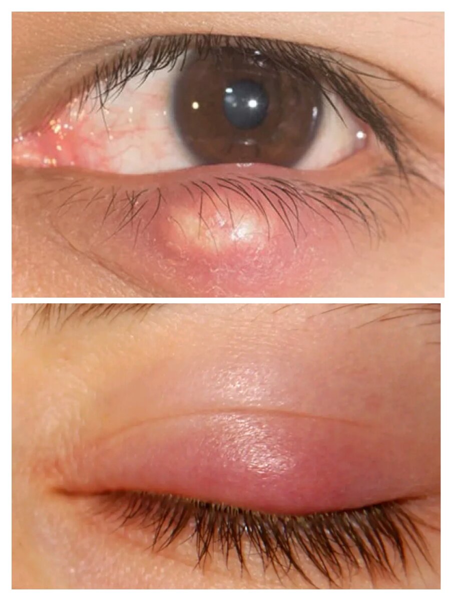 👆Ячмень👆