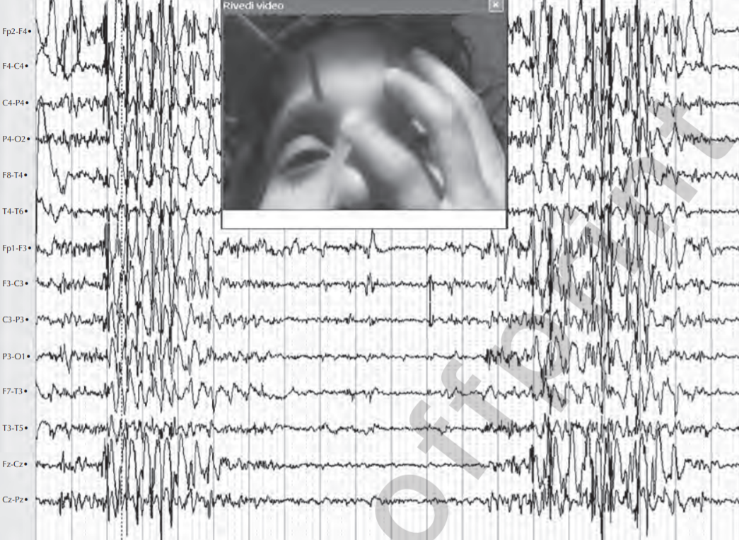 Генерализованная спайк-волновая активность на ЭЭГ во время приступов, спровоцированных ярким источником света