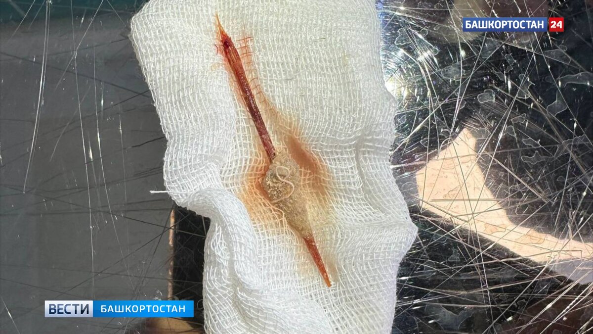    Уфимские врачи извлекли зубочистку из уретры 7-летней девочки
