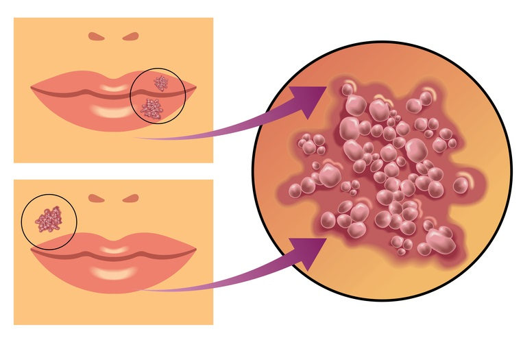 Сама себе лекарь: как быстро вылечить герпес и простуду на губе