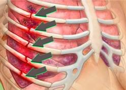 Переломы ребер и их последствия - как правильно лечить