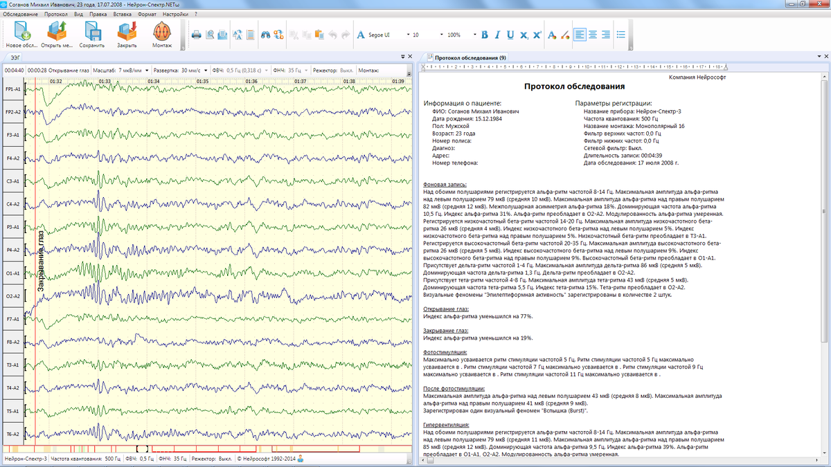 Доминирующий альфа ритм. Нейрон-спектр-4/п. Прибор Нейрон спектр 2 энцефалограммы. Электроэнцефалограф 32-канальный Нейрон-спектр-5. Протокол обследования электроэнцефалограммы норма.