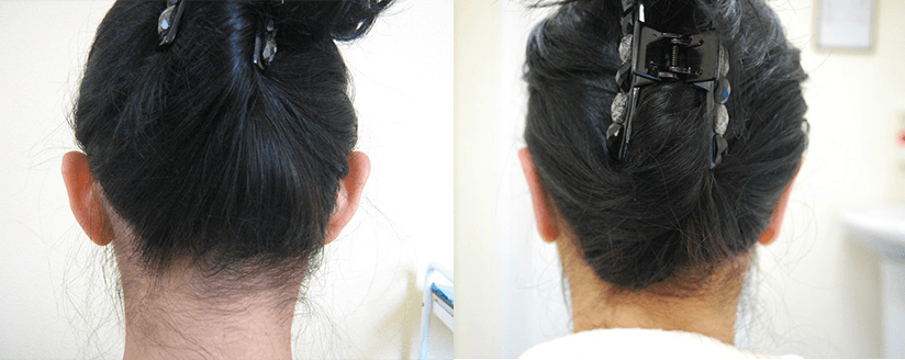 Фото до и после отопластики. Фото с сайта Д.Р. Гришкяна. Имеются противопоказания, требуется консультация специалиста