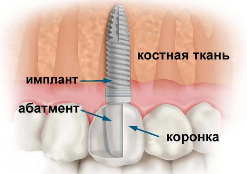 Этапы и сроки имплантации зубов