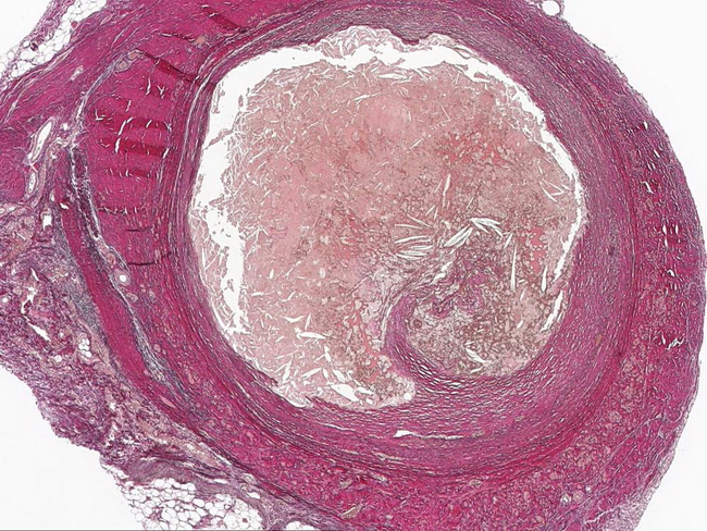 Микроскопическая картина атеросклероза аорты
