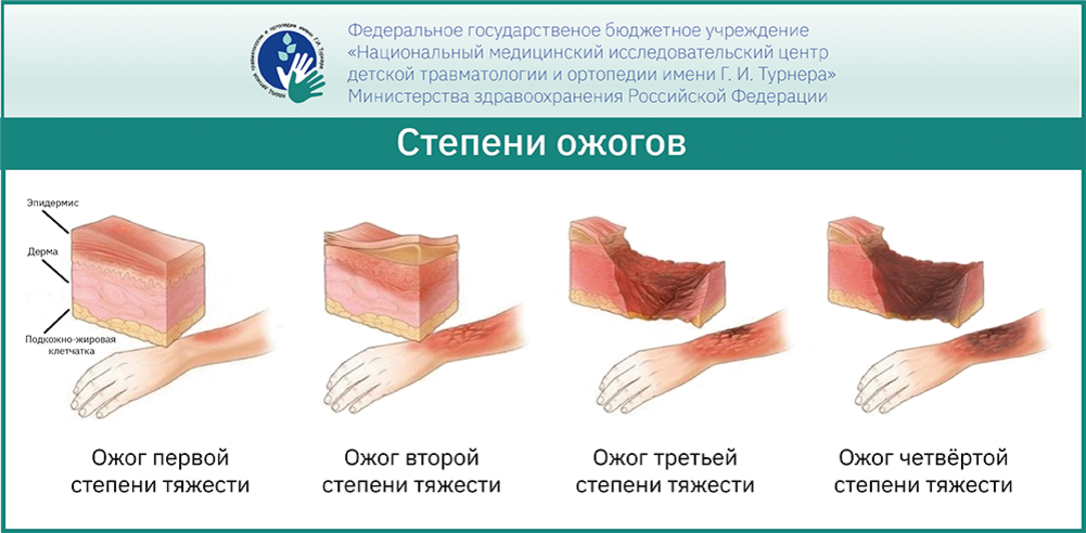 Помощь при ожогах у детей