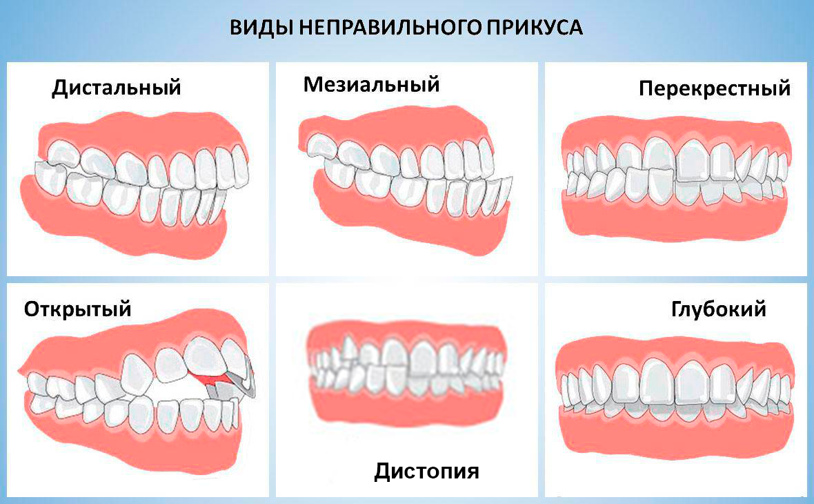 Почему зубы отличаются между собой у разных. Правильный прикус вид сбоку. Правильный прикус зубов сбоку. Правильный прикус у человека схема сбоку. Прикус ортогнатический зубов.