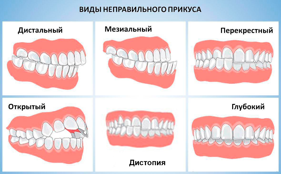Дистальный прикус картинки