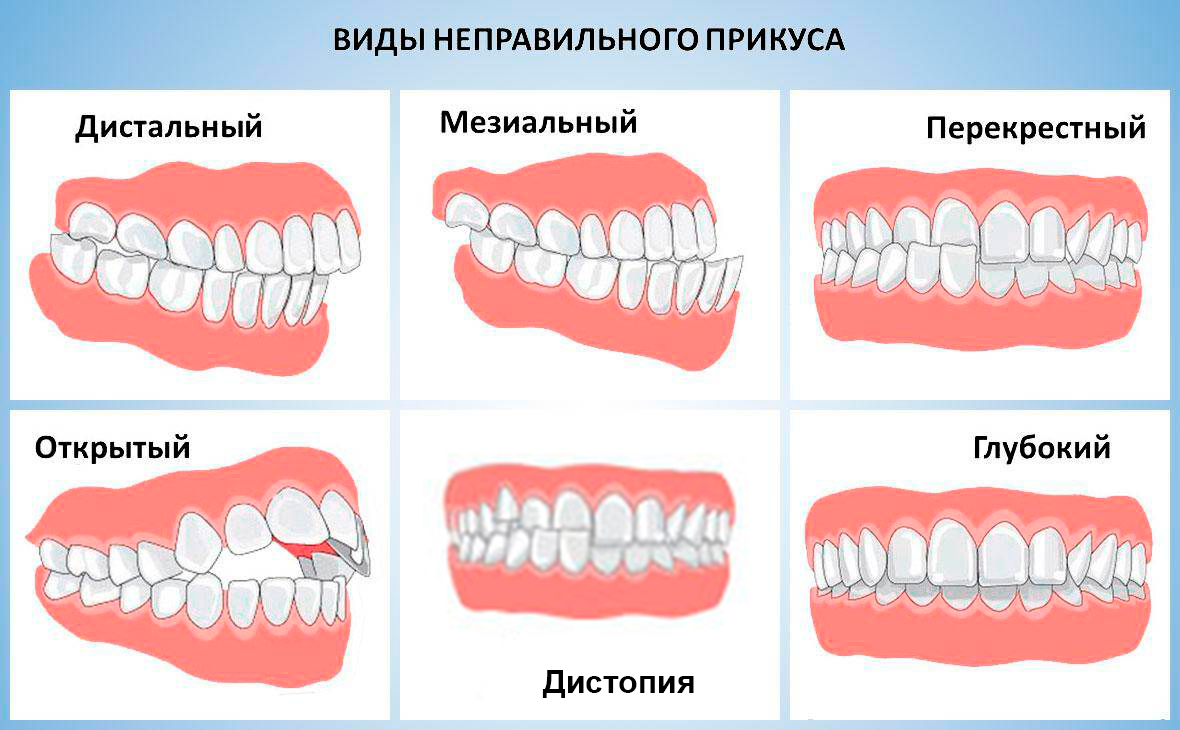 Остался привкус. Правильный прикус вид сбоку. Правильный прикус зубов сбоку. Правильный прикус у человека схема сбоку. Прикус ортогнатический зубов.