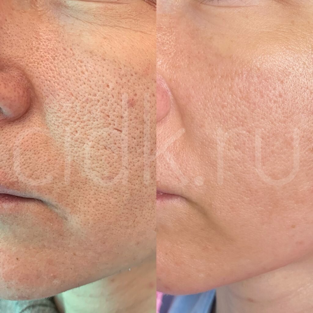 Игольчатый RF-лифтинг до/после