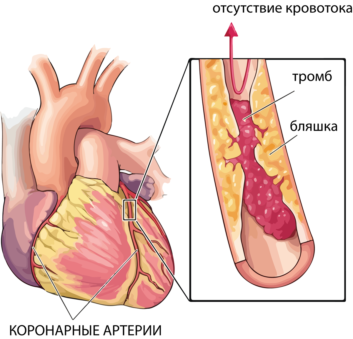 Ишемическая болезнь сердца: симптомы и лечение