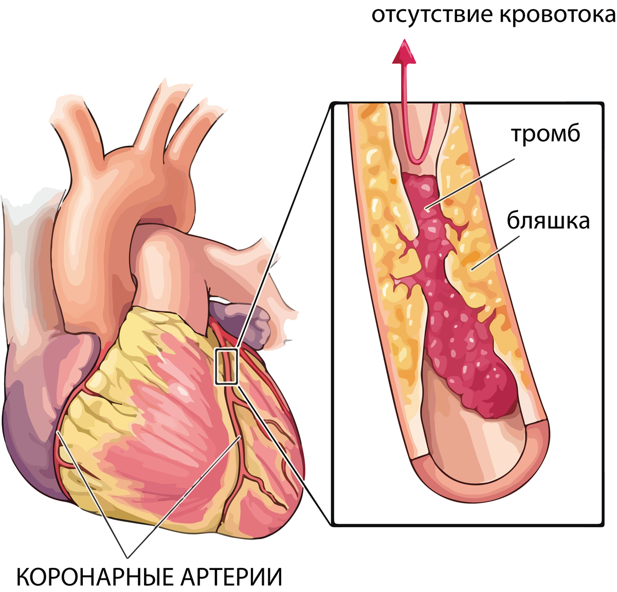 Лечение сердечно сосудистых заболеваний