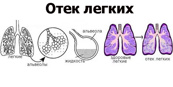 Сердечная астма: причины, симптомы, признаки, диагностика и лечение патологии в Клинике МЕДСИ