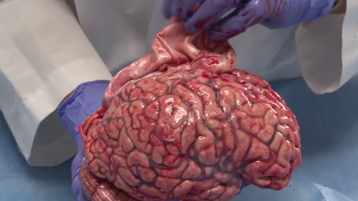 Аутопсия человеческого мозга. Источник фото: youtube.com.