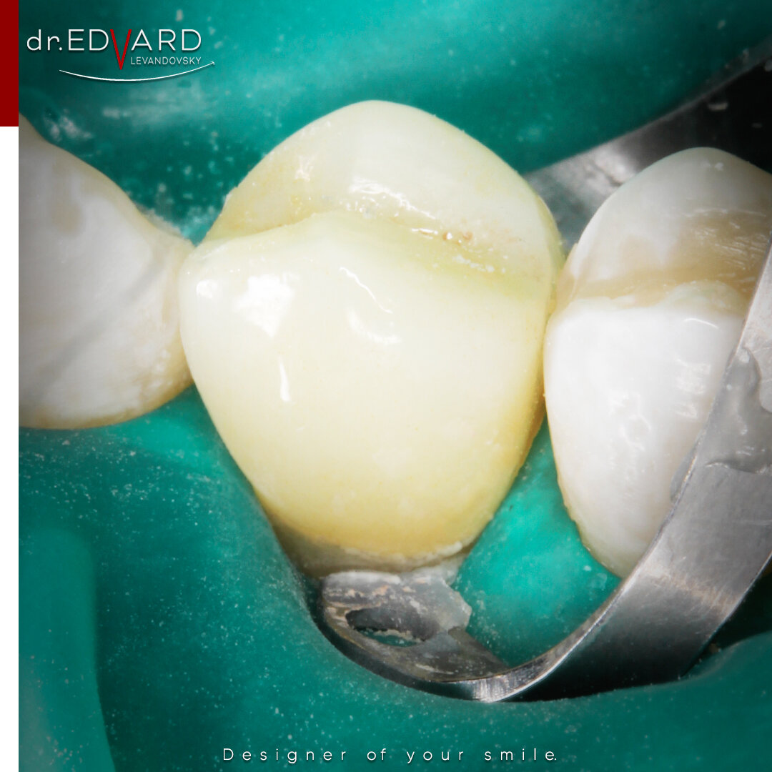 Керамическая коронка