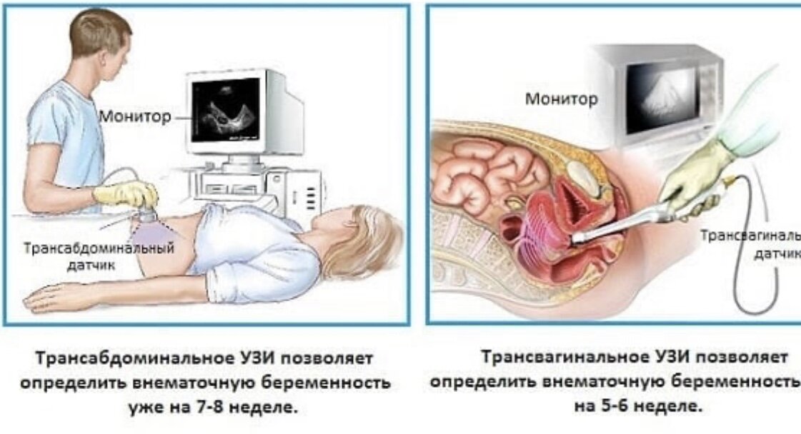 УЗИ для определения беременности