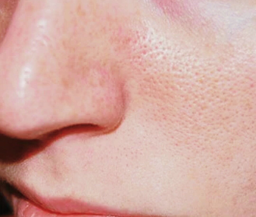 Почему расширяются поры на лице и как улучшить состояние кожи | Настасья  Самарина | творчество | Дзен