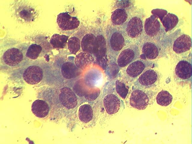 Аденокарцинома молочной железы. Опухоль эпителиальной природы, требующая агрессивного хирургического иссечения. Раковые клетки расположены ацинарно, сохраняя связь между собой внутри группы.