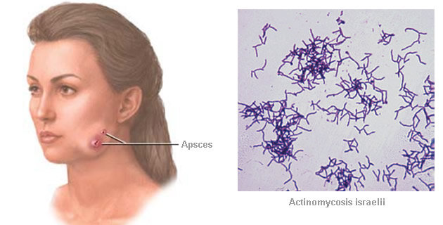 Актиномикоз клиническая картина