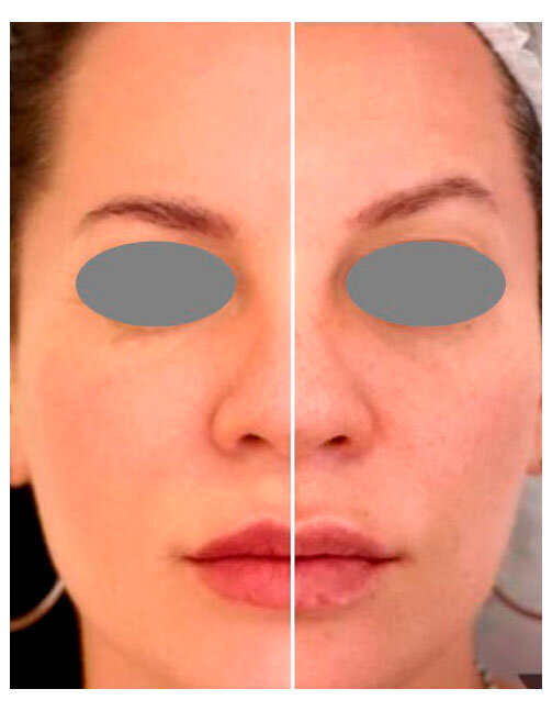 Результат работы ДО/ПОСЛЕ процедуры Fotona VectorLift. Лечение проводил доктор Adrian Gaspar, Аргентина