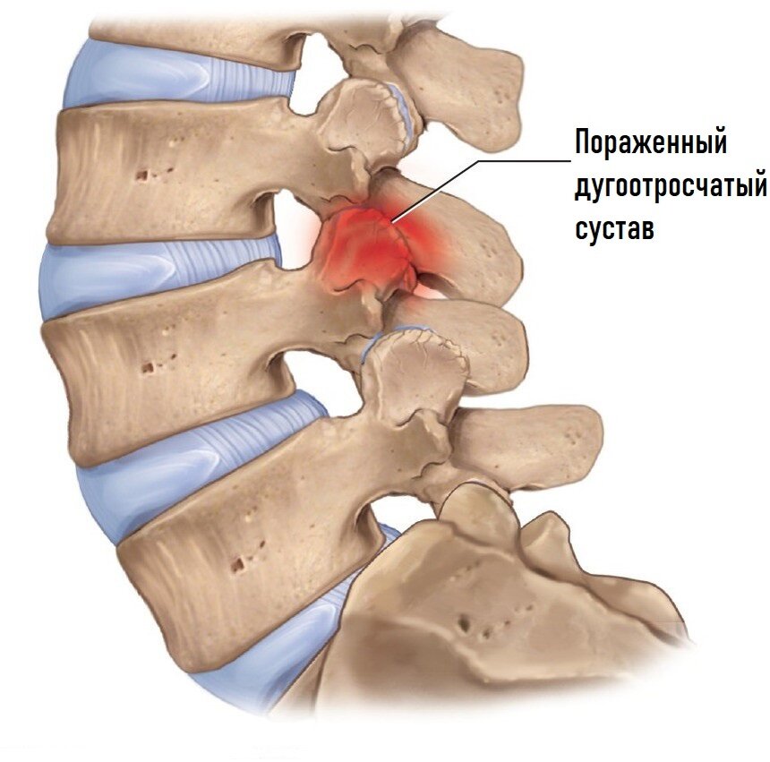 Фасеточные суставы позвоночника картинки