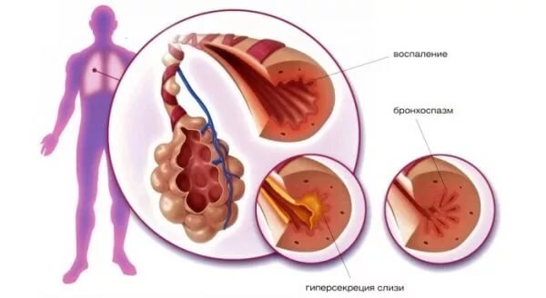 Аллергический бронхит