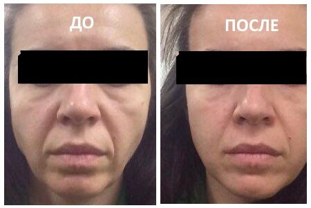 Результат после курса массажа 12 процедур