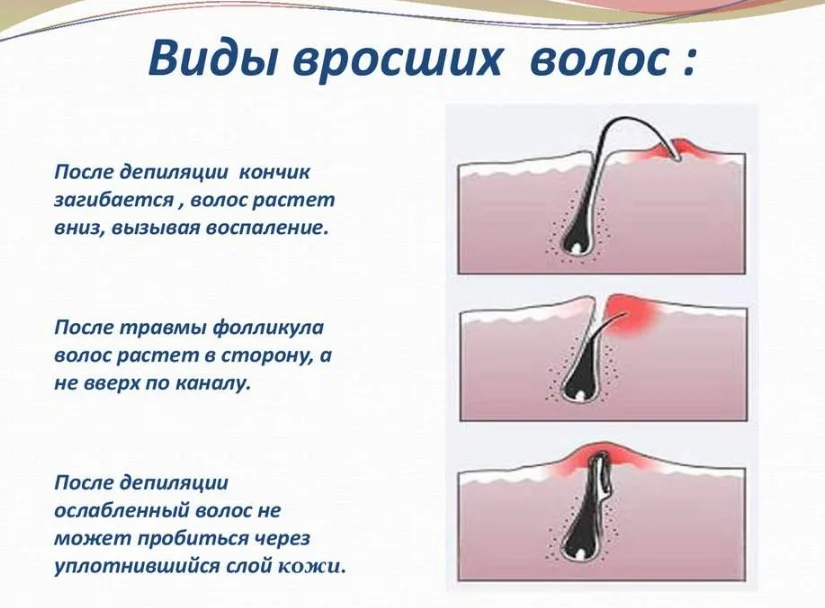 Как выглядит вросший волос на голове Pin on face