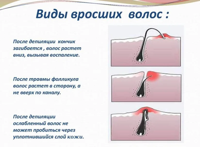 Шугаринг волосы перестают расти. Типы вросших волос плакат. Типы вросших волос при депиляции. Вросшие волосы типы вросших волос.